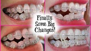 Design your own braces with color bands. Wearing A Rubber Band 8 Month Braces Update Youtube