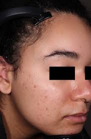 These 4 cases of GPP provide real-world evidence that spesolimab is an  effective and safe treatment for GPP flares