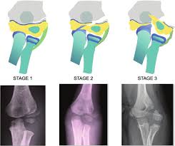 Image result for Lateral Condyle Fracture