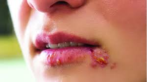 It actually depends on multiple factors thus mri scan cost in bangalore is also variable. Herpes Simplex Treatment In Bangalore Herpes Infection