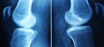 Was Ist Der Unterschied Zwischen Arthrose Arthritis Und Rheuma