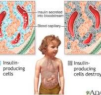 Type 1 diabetes: MedlinePlus Medical Encyclopedia