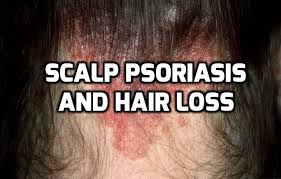 Scalp psoriasis is not the sole cause of hair loss. Hair Loss Due To Scalp Psoriasis Is Not Permanent Psoriasis Hair Loss Psoriasis Remedies Scalp Skin Problems Psoriasis