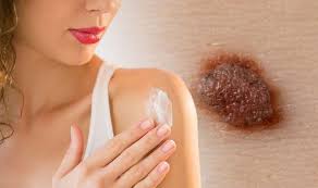 Is a raised mole always cancerous? Skin Cancer How Often To Apply Sun Cream To Prevent The Condition Express Co Uk