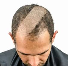 Now you see it, now you don't. Buzz Cut Or Bald And Shaved Head How To Choose Ready Sleek