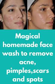 Find Out What Are The Top 7 Melaleuca Oil Benefits On Your Health Homemade Face Wash Remove Acne Face Wash