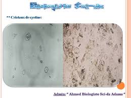 Cristaux oxalate de calcium dans les urines traitement. Types De Biologistes Sci Dz Labo D Analyses Medicales Facebook