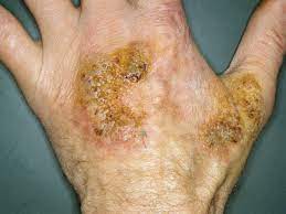 Tuberculosis cutis verrucosa (1) cutaneous tuberculosis, exogenous inoculation type; Tuberculosis Cutis Verrucosa Altmeyers Enzyklopadie Fachbereich Dermatologie