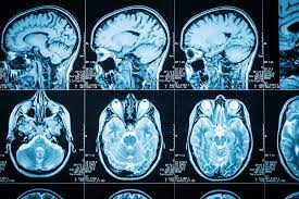 Ct Scan Kepala Prosedur Resiko Hasil Tes Hello Sehat