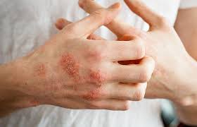 Schuppenflechte Ursachen Symptome Und Therapie Minimed At