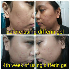 For getting rid of wrinkles i find differin not really effective. Marionette How I Got Rid Of My Acne Breakouts My Differin Gel Acne Treatment Journey