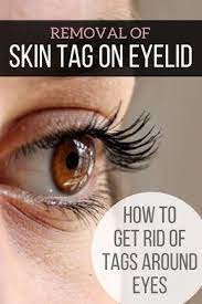 Skin tags mostly appear on the areas of your body where skin rubs against skin like your eyelids, neck, the area under the breasts, and under the have you already tried any remedies to remove skin tags? Pin On Wefts