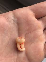 As of right now i don't really have a reason to, other than maybe some cosmetic crowding of my front lower teeth. My Wisdom Tooth Has A Hook Teethgoneextracted