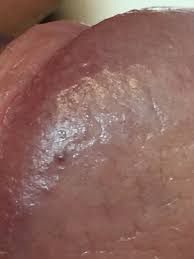 Tumores Benignos Pagina 2 Dermatologo Net