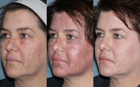 Treatment of melasma with the 1,927‐nm fractional thulium fiber laser: A  retrospective analysis of 20 cases with long‐term follow‐up
