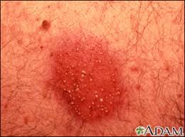 Image result for dermatitis contacta allergica