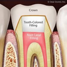 This tooth had a large cavity. 3 Reasons A Root Canal Treatment Might Fail And What You Can Do About It Live Oak Aesthetic And Family Dentistry