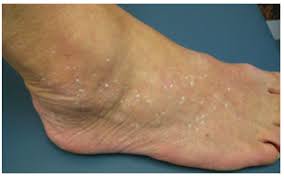 Molluscum contagiosum is a skin disease that causes painless pink bumps on the skin. Online Learning Module Benign Skin Lesions Molluscum Contagiosum Warts Flashcards Quizlet