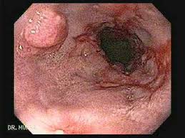 • visualization of catarrhal and erosive and ulcerative lesions of the lower third of the esophagus a biopsy for the purpose of histological examination. Esophagitis El Atlas Gastrointestinal Gastrointestinalatlas Com