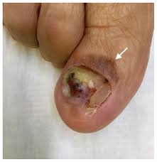 Melanomas can also occur in areas that don't receive much sun exposure, such as the soles of your feet, palms of your hands and fingernail beds. Subungual Melanoma Cmaj