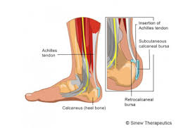 Haglund's syndrome is group of symptoms namely haglund's deformity (exostosis of lateral calcaneum) with retrocalcaneal bursitis.1 it is often accompanied by achilles tendinitis. Haglund Deformity Correction In San Francisco By Dr James Chen