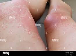 Image result for allergy rash on the legs