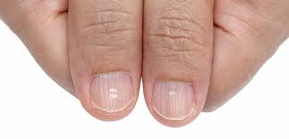 Unghiile pot avea aceste pete albe sau pot deveni albe pe jumatate sau cu totul. Pro Tv Petele Albe De Pe Unghii De Ce Apar Si Cum Poti Scapa De Ele