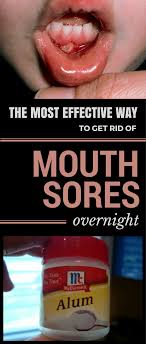 Biting The Inside Of Your Cheek Treatment The Most Effective Way To Get Rid Of Mouth Sores Overnight Beautyhacksovernight Mouth Sores Mouth Ulcers Sore In Mouth Remedies