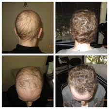 You could get a range of appearances by including a tough part, awesome. Tm Hair Chemotherapy Hair Loss And Solutions
