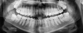 Over 34,485 cavities pictures to choose from, with no signup needed. Ingeniously Simple Dental Treatment Could Heal Tooth Cavities Without Any Fillings