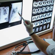 Image result for lung cancer xray