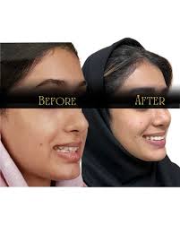 Non extradition orthodontic treatment. زیباتر لبخند بزنید🥰 رفع بهم ریختگی  دندانها بدون کشیدن دندانها. #dentistlife #dentistrylife #smiles #دندانها  #دندان_پزشک #متخصص_ارتودنسي_اصفهان #ارتودنسي #دكتر_رويا_هاشمي #اكسبلور