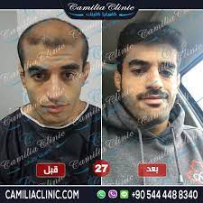 pin by mesfr on الشعر in 2021 hair transplant results hair transplant hair transplantation