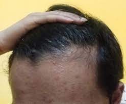 Since women develop hair loss for many reasons and each requires different treatment. Please Help Me Guys I M 15 Yo Boy Hairlosstalk Forums