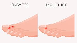 First, let's look at the overall shape of the foot. 10 Common Foot Problems And How To Manage Them Everyday Health