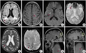 Asymptomatic Cerebral Small Vessel Disease Insights From Population Based Studies