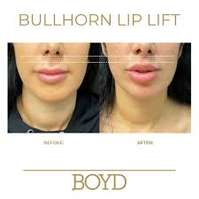 Bullhorn Lip Lift by @drcharlesboyd 👄 ✨ A Bullhorn Lip Lift shortens the  space between the base of the nose and upper lip, making the lips appear  fuller and more pronounced. This