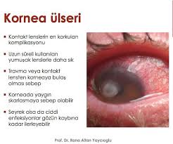 kornea (die)  cornea, transparent external coating of the eye. Facebook