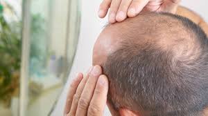 Usually, the bald patches appear suddenly and affect only a limited area. 6 Proven And Easy Ways To Regrow Hair In Bald Spots Yeg Fitness