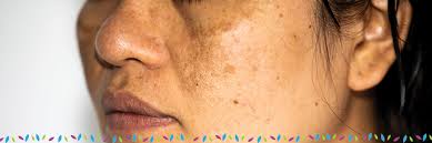 This image is from what controls variation in human skin color? Skin Discoloration Hyperpigmentation Affiliated Dermatology