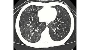 Others may develop popcorn lung after transplant. Popcorn Lung Symptoms Causes Treatment Prevention