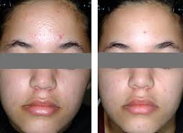 Blu U Blue Light And Levulan Combination Acne Treatment Los Angeles
