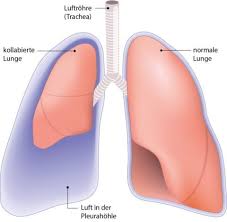 It serves for immediate diagnostics with dyspnoea, pain and fever at. Pneumothorax Ursachen Symptome Behandlung Ksw