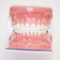 Es ist auch möglich feste zahnspangen von innen auf die zähne zu kleben. Kieferorthopadische Leistung In Stuttgart Unsichtbare Zahnspange Orthodontieplus