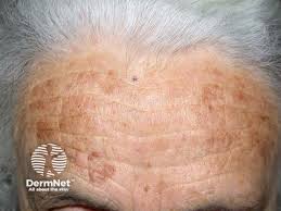 Image result for Diffuse Hyperpigmentation
