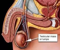 Lumps can be as small as a pea. What Are The Symptoms Of Testicular Cancer Quora