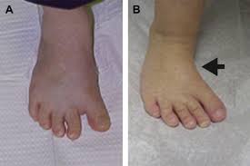 Image result for Hallux Varus