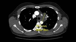 SCTS annual meeting 2023 abstracts