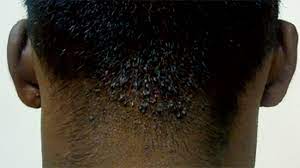 Hair bumps in men usually pop up as a bunch of small bumps on cheeks, chin or neck after they shave while in women, they are common on legs, armpits, buttocks and in other public areas. Red Spots On Scalp Pictures Causes And Treatments
