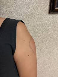 It's not clear why moderna vaccinations are more likely to produce the side effect, although. Moderna Vaccine Causing Covid Arm Among Some Patients Keye